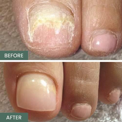 Before and after labels comparing yellow crumbly toenails with clear healthy toenails
