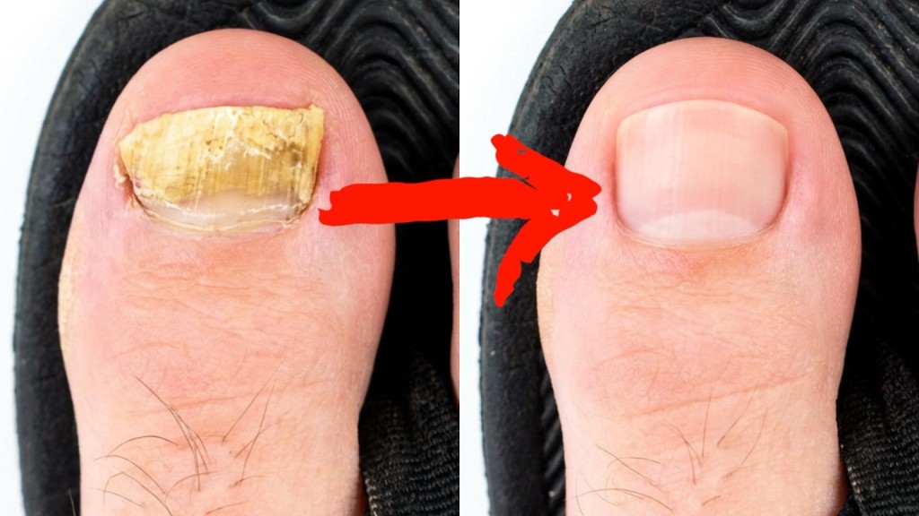 Before and after toenail comparison with arrow from yellow thick nail to clear healthy nail