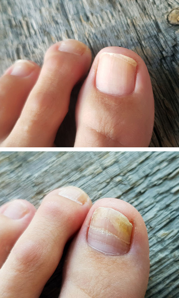 Comparison of clear healthy toenails versus thickened yellowed toenails