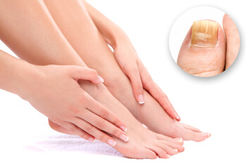 Healthy-looking feet with a close-up inset of a yellow, thick, brittle toenail